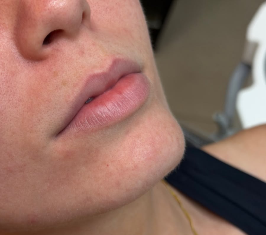 Lábios antes do procedimento de harmonização orofacial com a Dra. Carol Montes