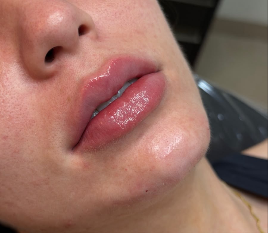 Lábios depois do procedimento de harmonização orofacial com a Dra. Carol Montes